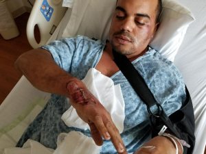 A Wilmington man, Vince Iventosch was run over by a vehicle and left bleeding in a parking lot after a night out, but police are saying no criminal charges will be brought against the driver who fled the scene (Port City Daily photo/COURTESY SANDI IVENTOSCH)