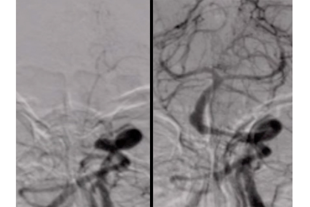 Moments before and after a thrombectomy is performed, showing blood flow restored to the brainstem, or the "widow maker" as Dr. Jeffrey Beecher calls it. (Port City Daily/Courtesy Dr. Jeffrey Beecher)