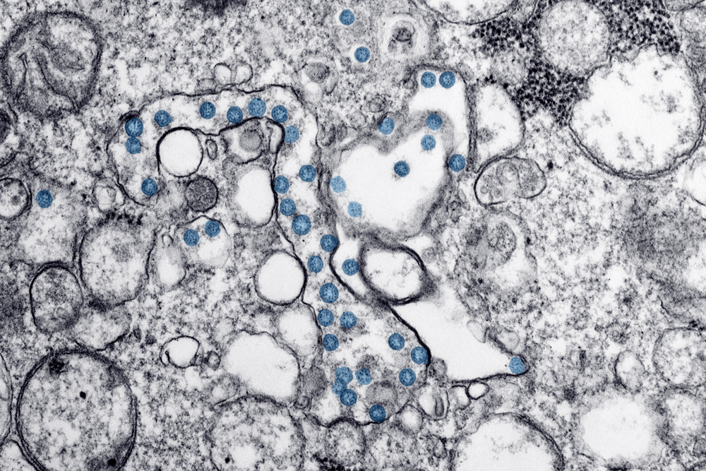 An electron microscopic image of an isolate from the first U.S. case of Covid-19. The spherical viral particles are seen in blue. (Image courtesy CDC)